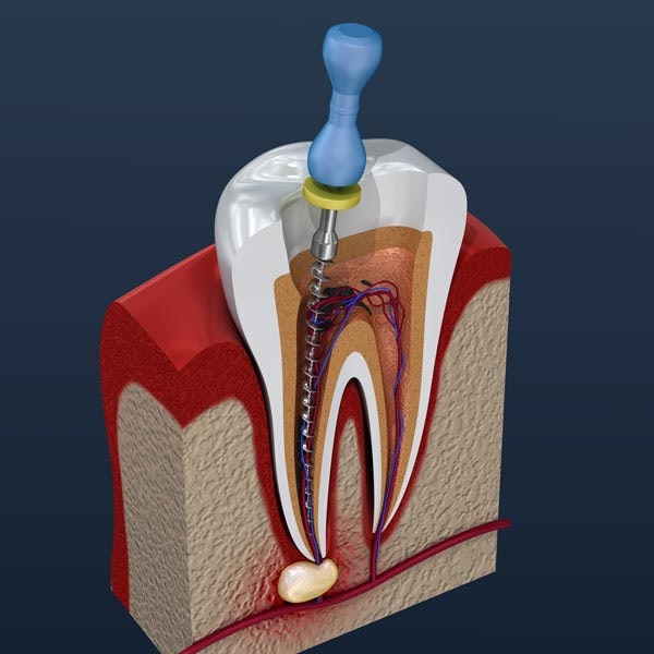 Diagram of root canal