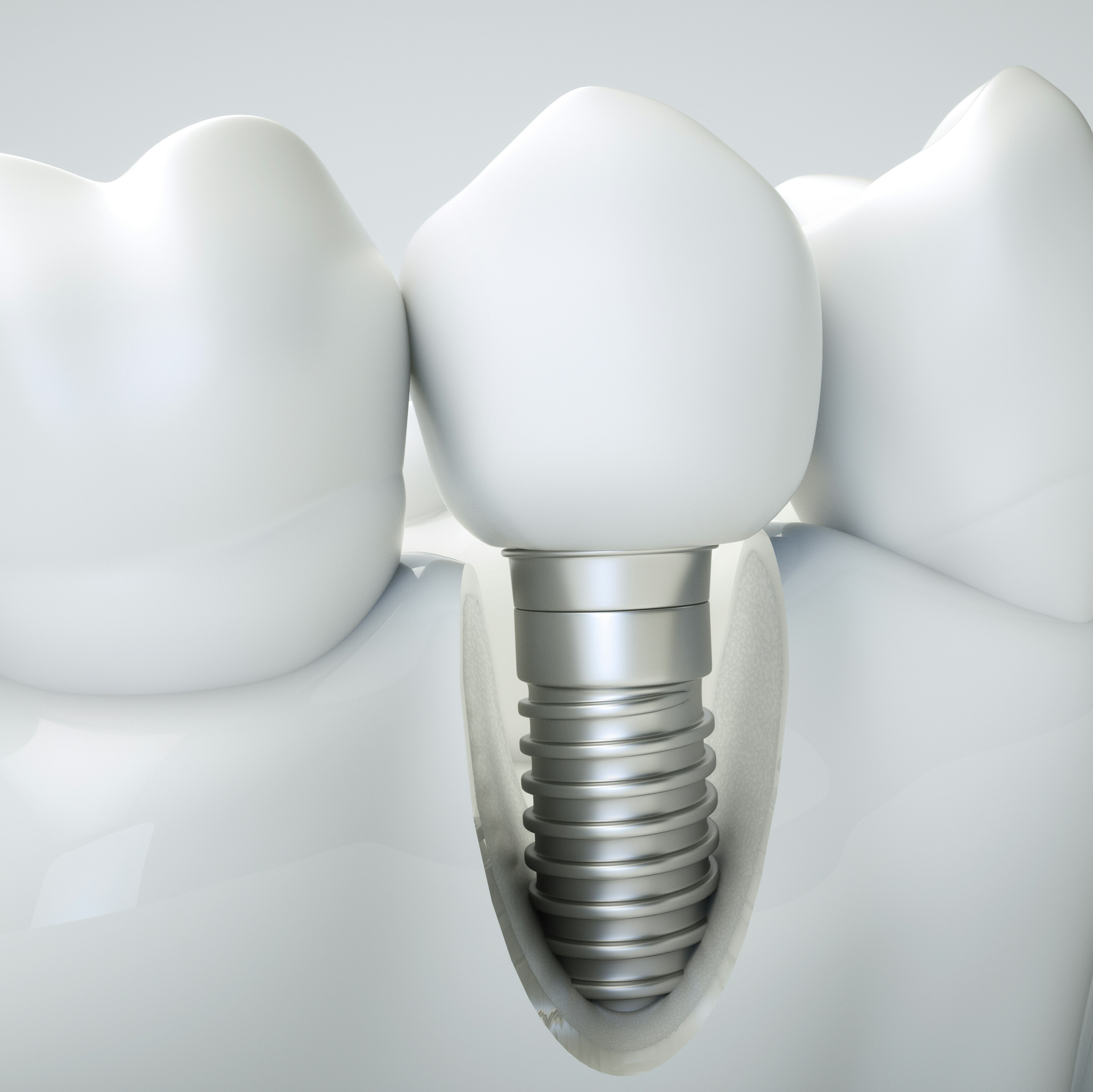 Dental Implant