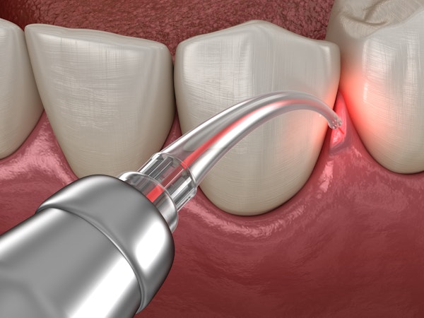 gum disease therapy laser treatment