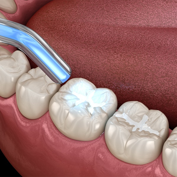 3d rendering of a tooth filling
