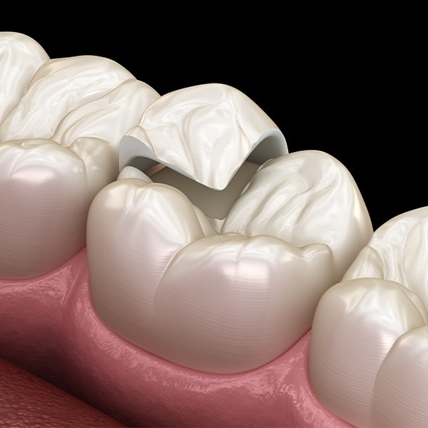 3d rendering of a tooth crown