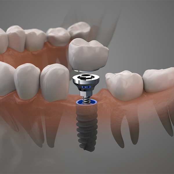 3d rendering of a dental implant