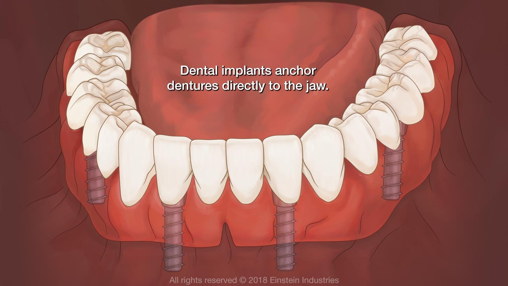 Diagram showing how implants secure a denture to the jaw.