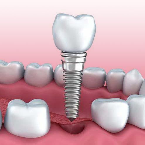 Implant-Supported Crown