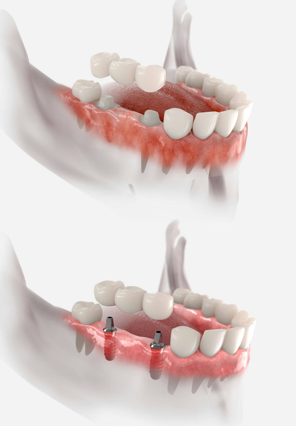 traditional bridge and implant-supported bridge