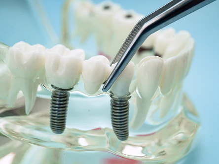Dental implants model