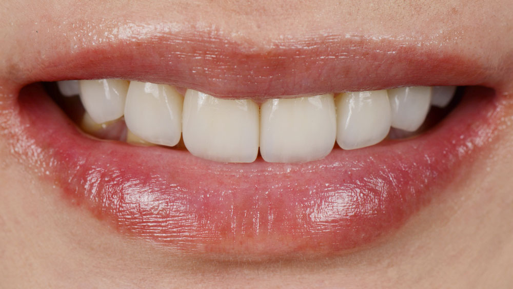 After Smile Makeover