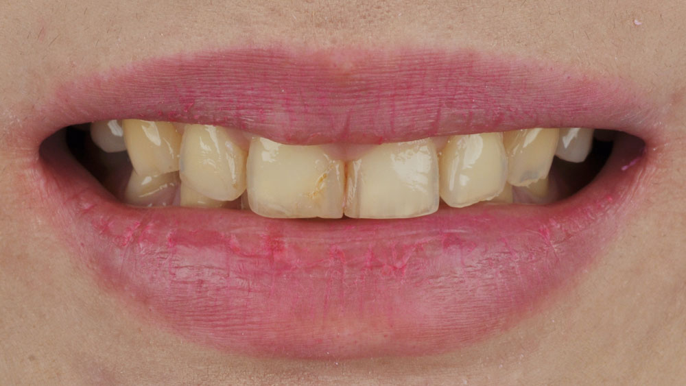 Before Smile Makeover