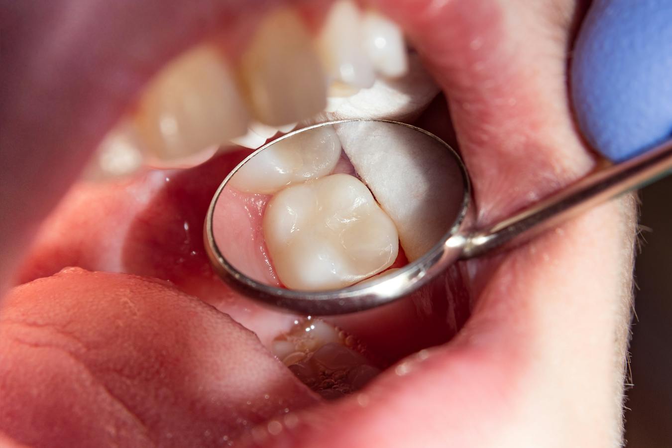 dental mirror examining tooth