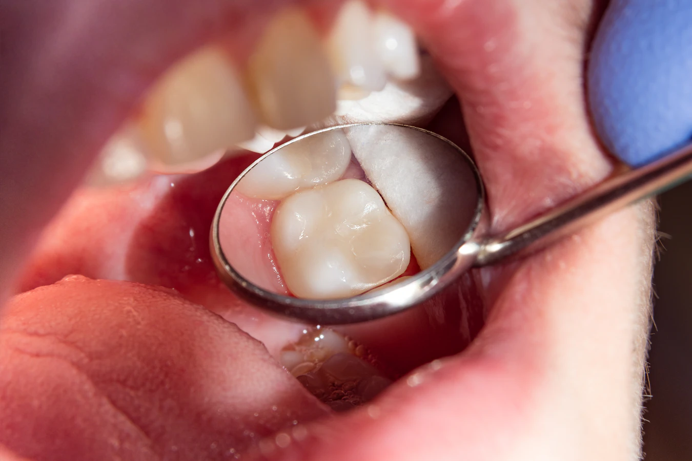 dental mirror examining tooth