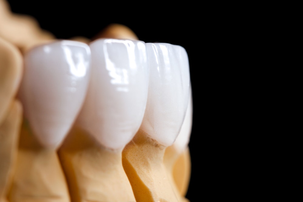 porcelain veneers
