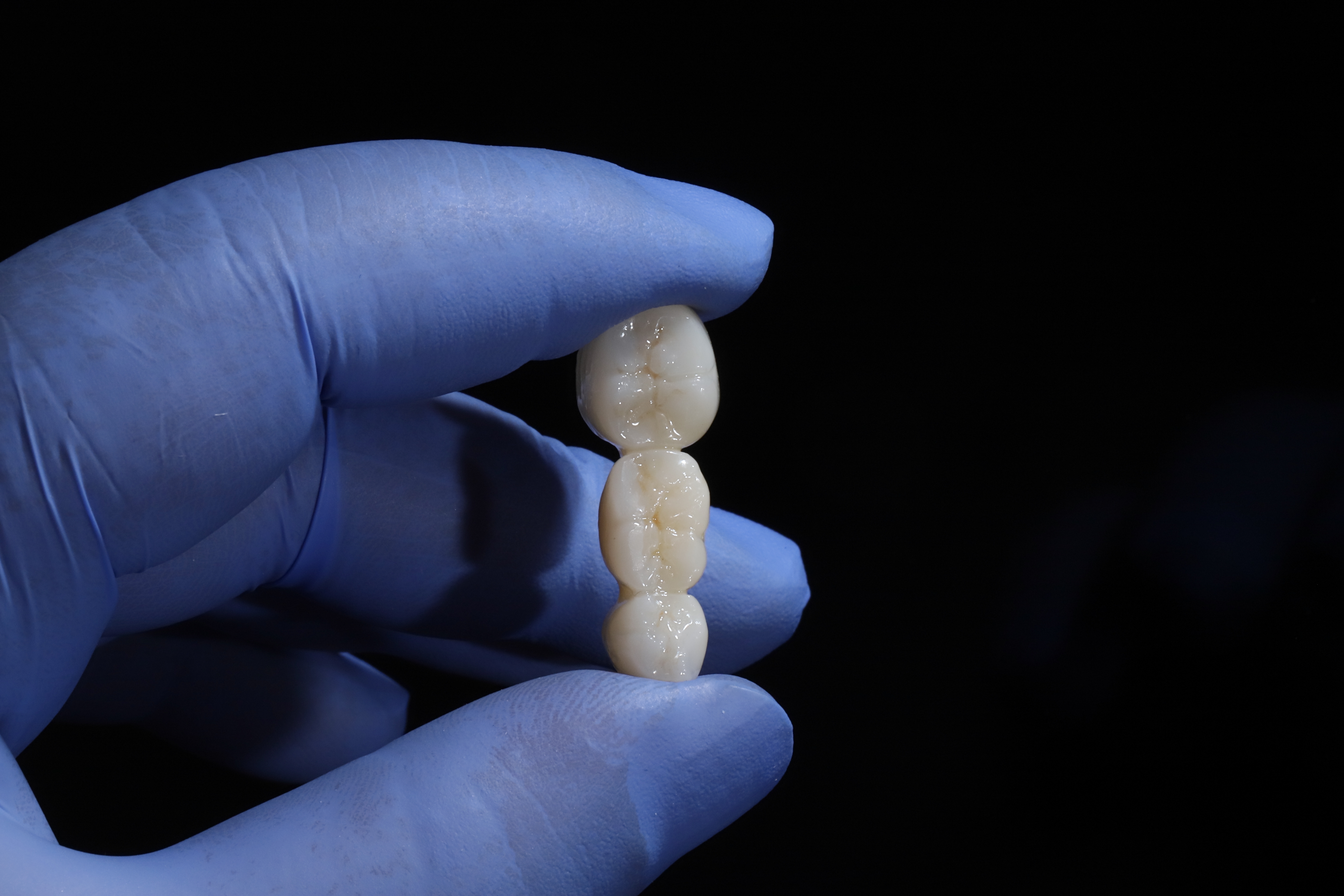 Dental Bridge