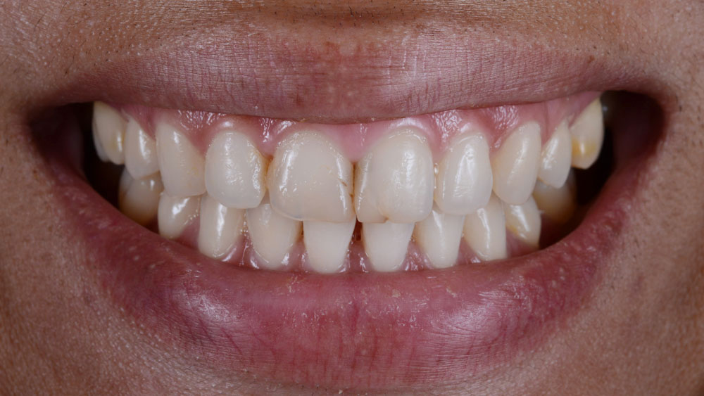 Before Veneers