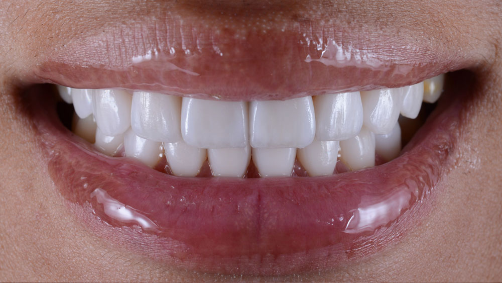 After Veneers