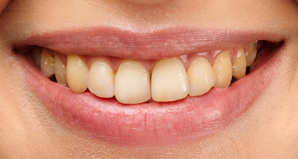Before Teeth Whitening