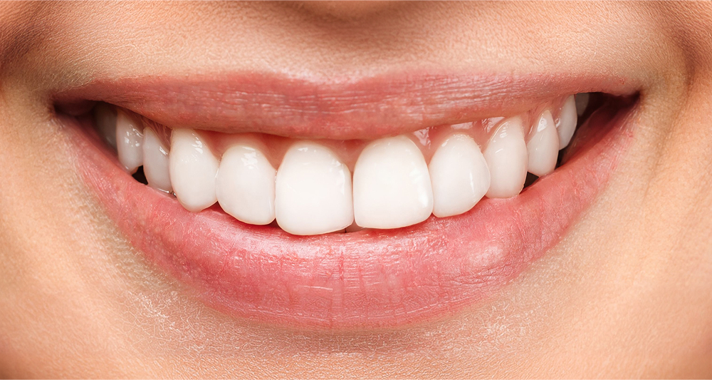 After Teeth Whitening