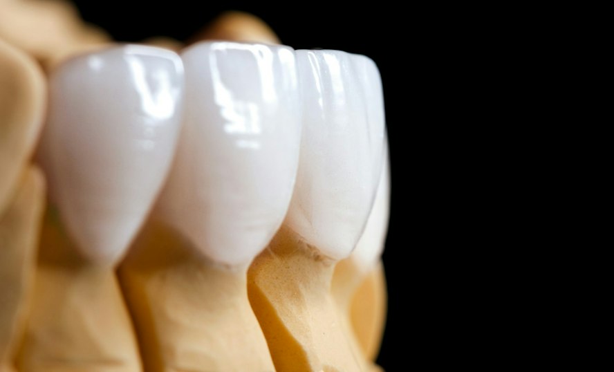 Custom porcelain veneers on a dental model