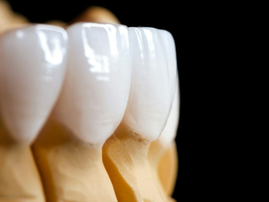 Custom porcelain veneers on a dental model