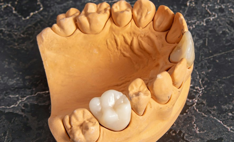 Tooth-colored dental crown on a dental model