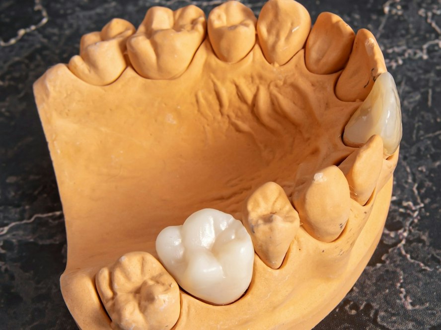Tooth-colored dental crown on a dental model