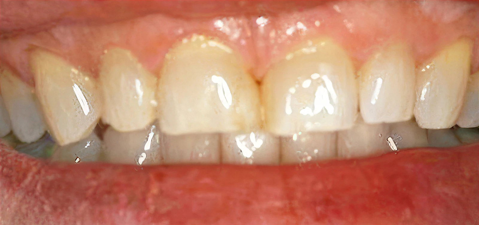 Smile before teeth whitening and dental bonding at Dearborn Family Dentistry