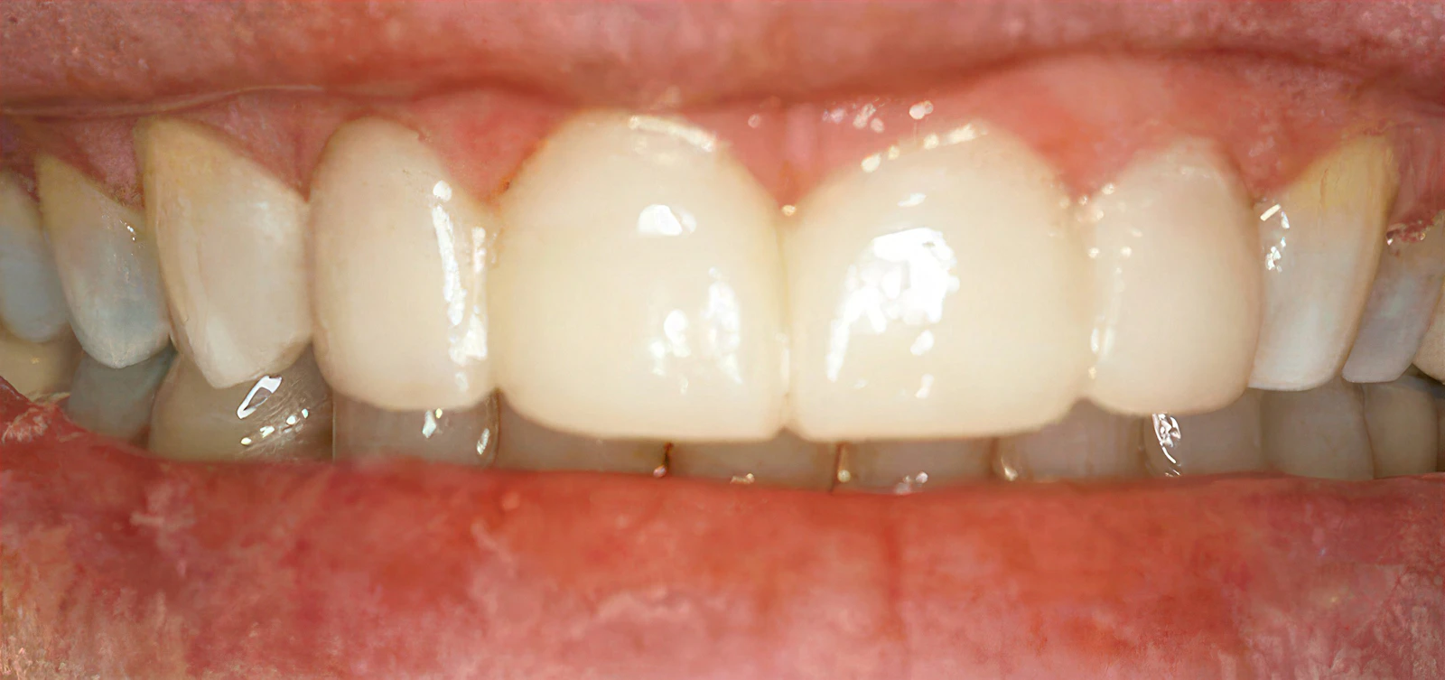 Smile after KöR teeth whitening and dental bonding at Dearborn Family Dentistry