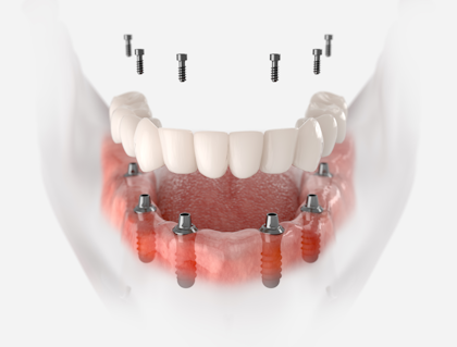 illustration of implant-supported dentures