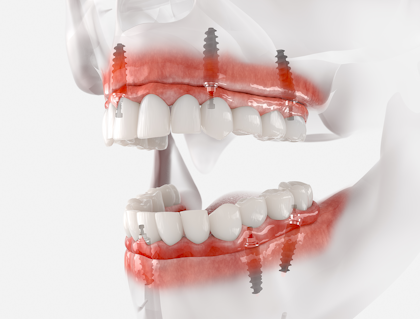 illustration of all-on-four dentures