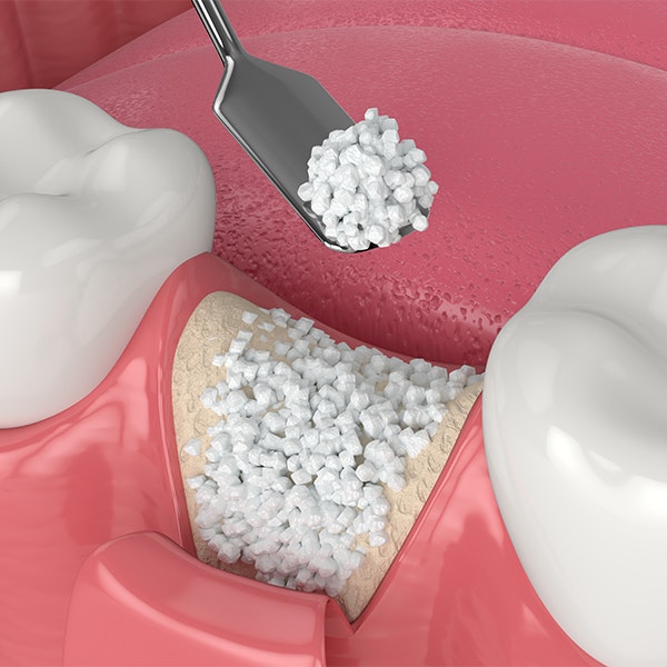bone graft illustration