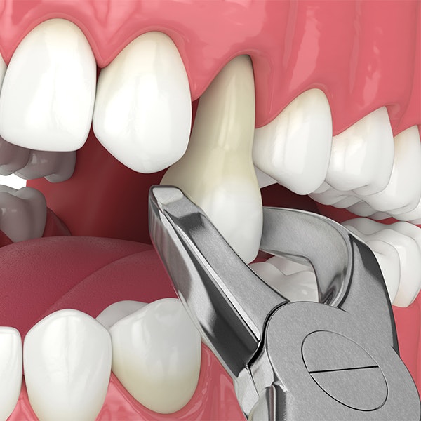 tooth extraction illustration