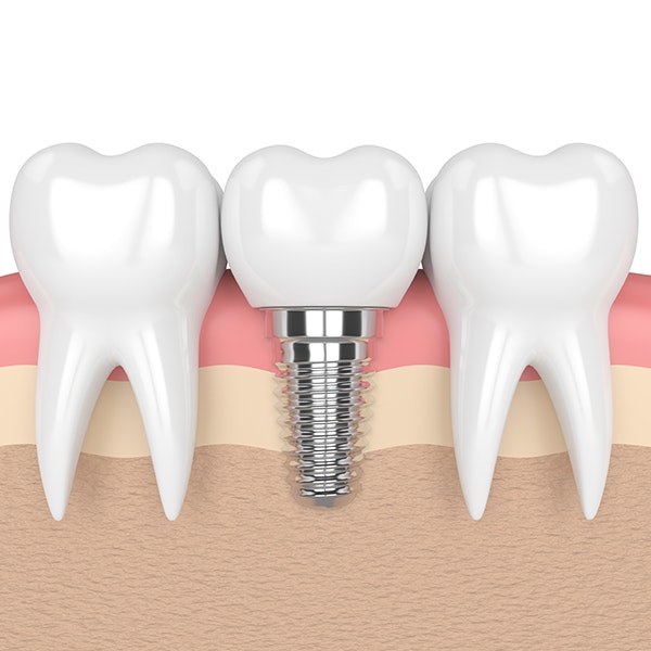 dental implant illustration