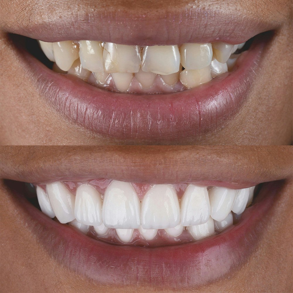 Before and after veneers