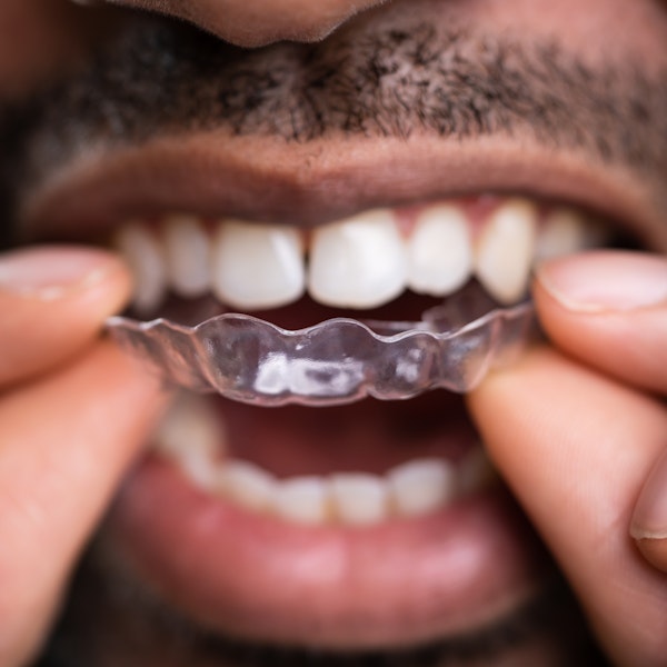 Clear aligner