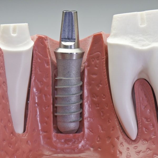 Close up of a dental implant model