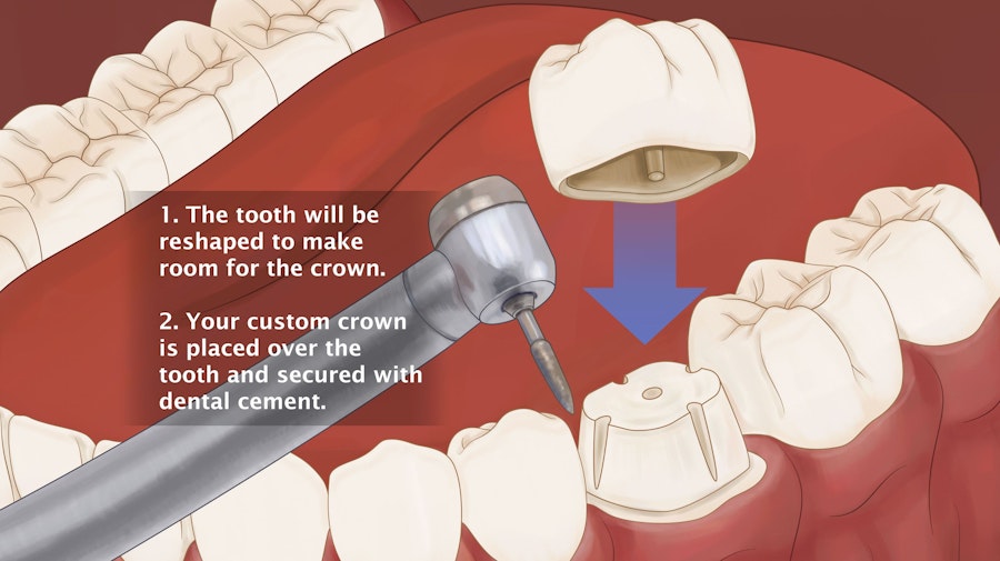 1. The tooth will be reshaped to make room for the crown.  2. Your custom crown is placed over the tooth and secured with dental cement.