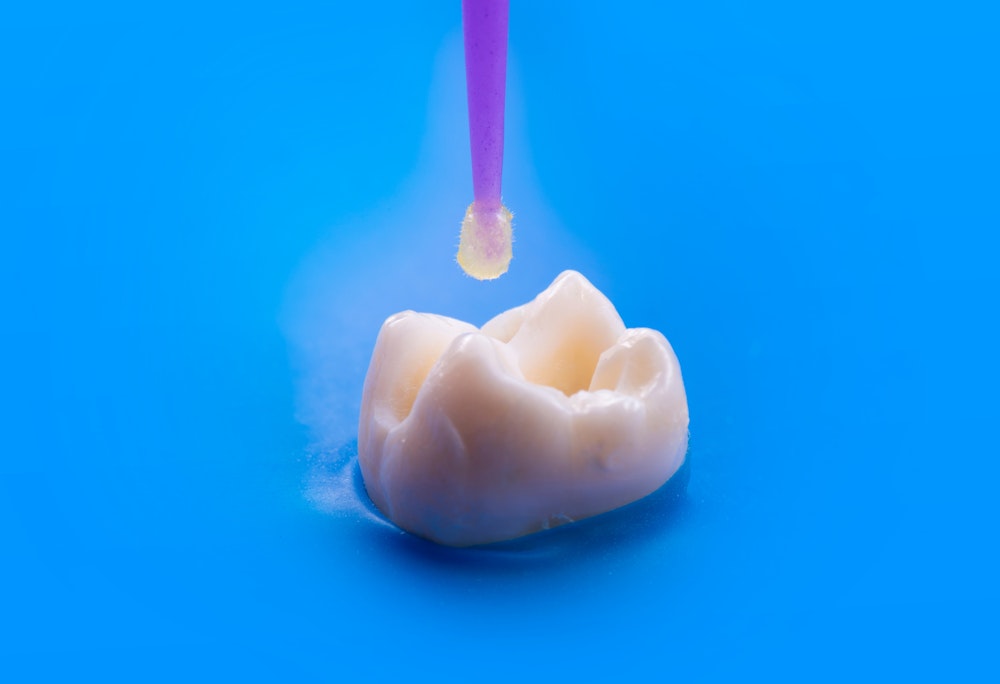 dental bonding paste being applied to a tooth