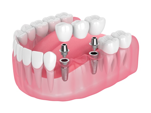 Implant-supported bridge illustration