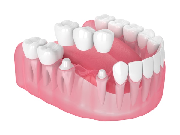 Traditional dental bridge illustration