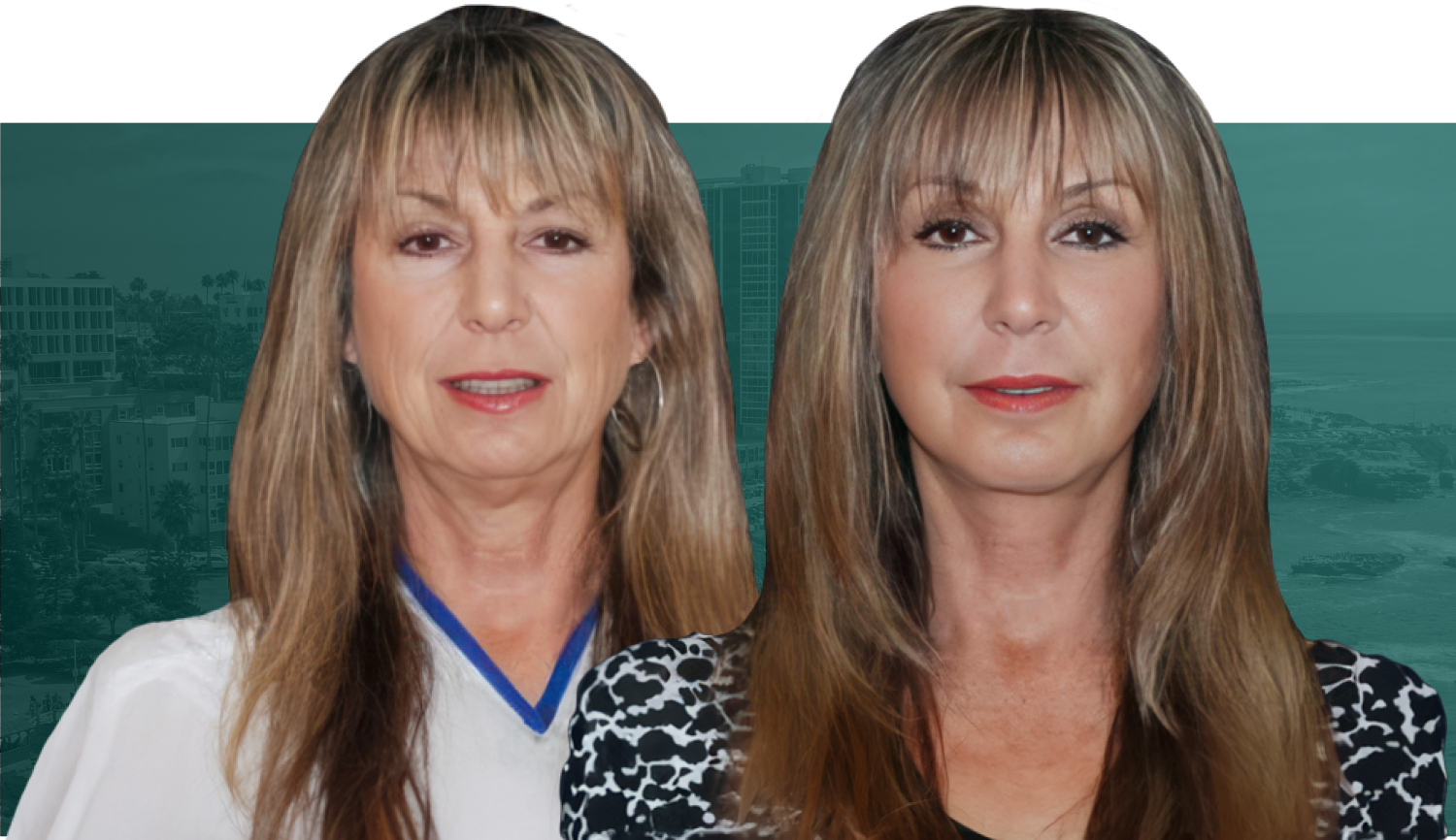 woman before and after plastic surgery by robert singer