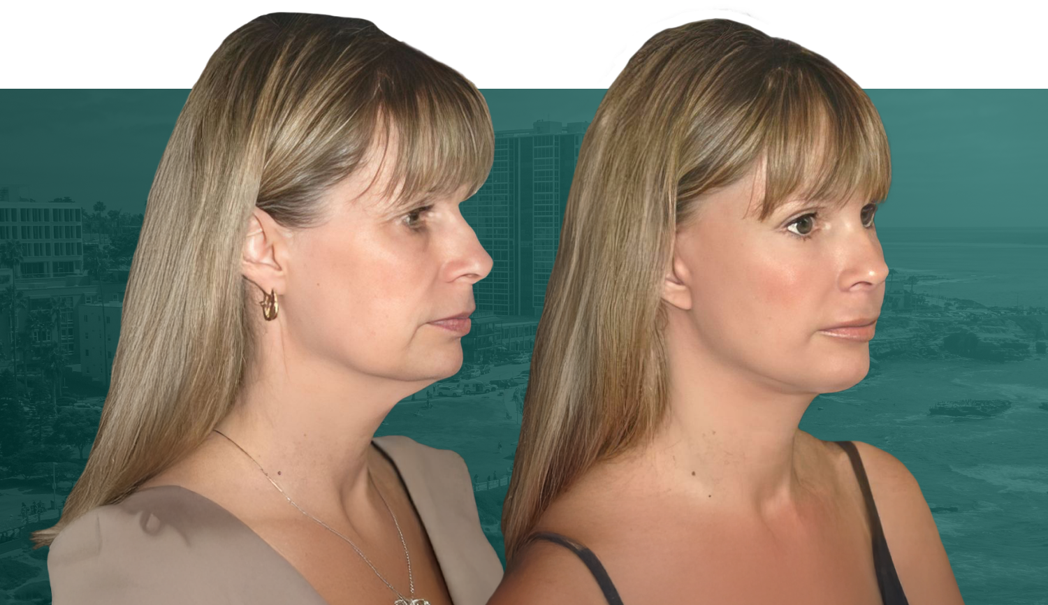 mini facelift before and after