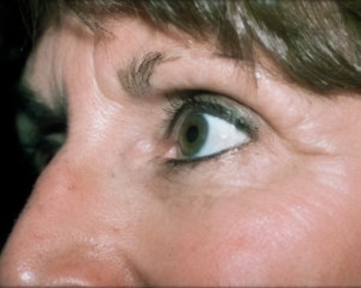 Dr. Robert Singer's patient before eyelid surgery