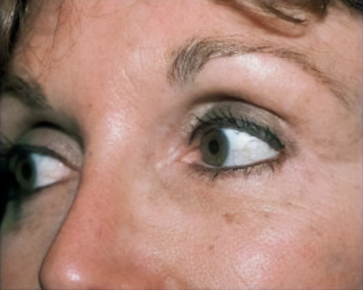Dr. Robert Singer's patient after eyelid surgery