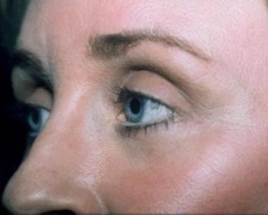 Dr. Robert Singer's patient after blepharoplasty