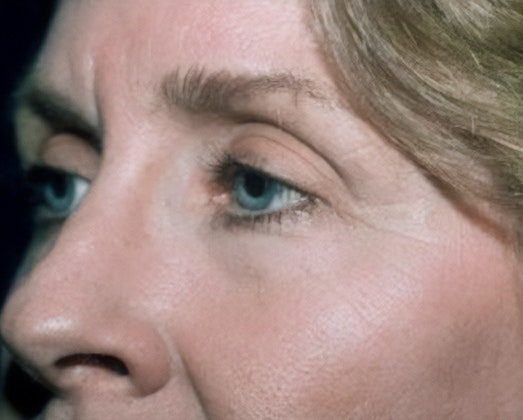 Dr. Robert Singer's patient before blepharoplasty