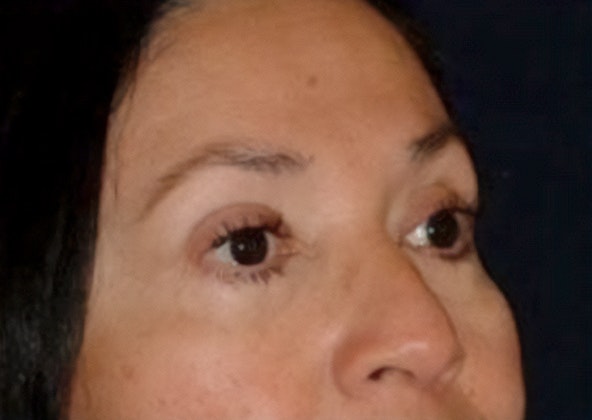 after eyelid lift