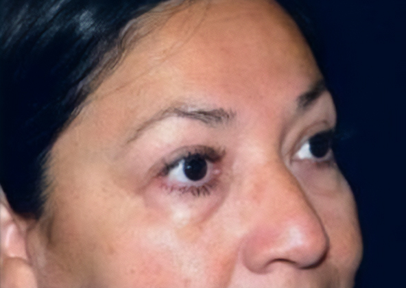 before eyelid lift