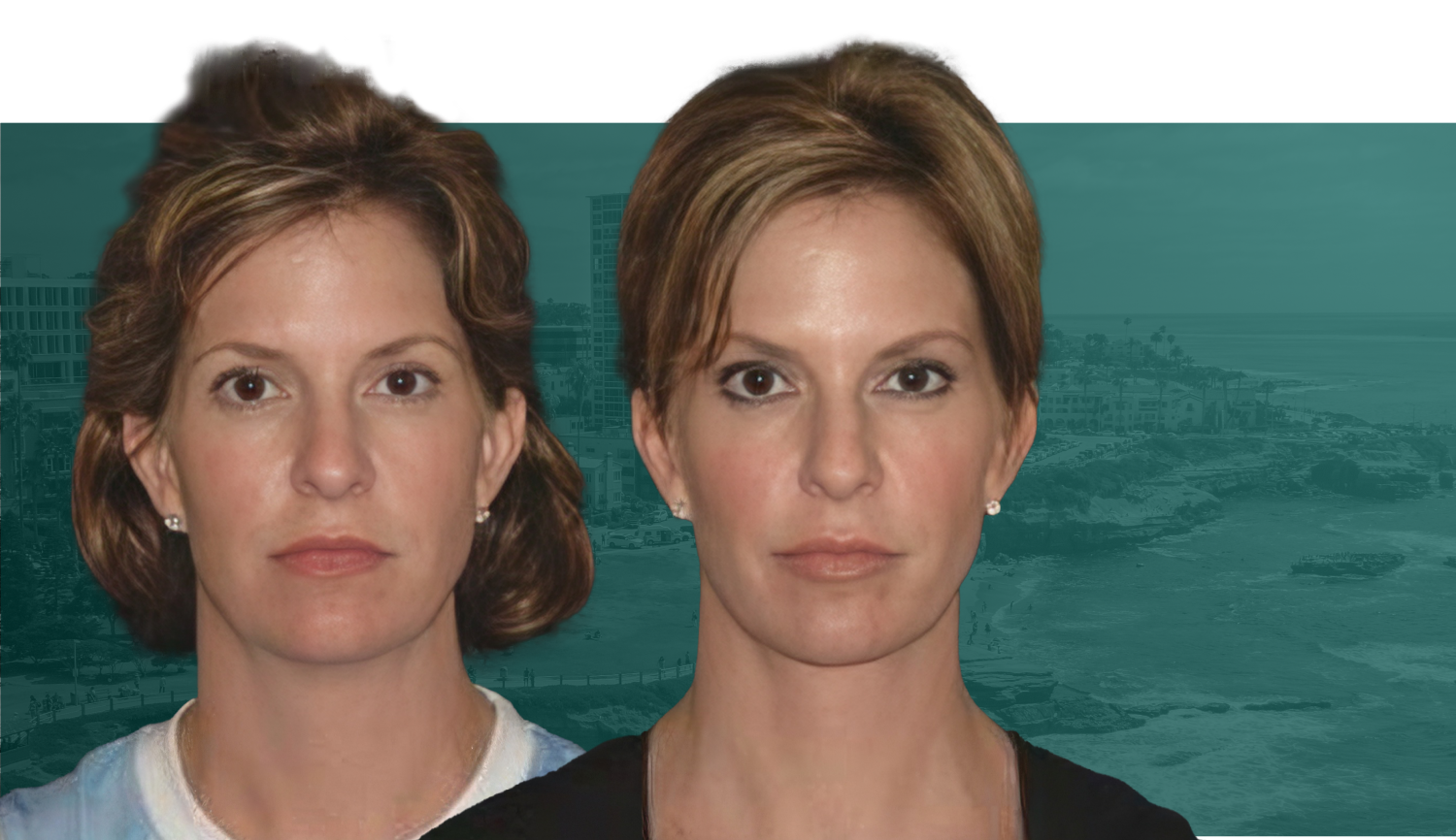 La Jolla patient before and after a brow lift