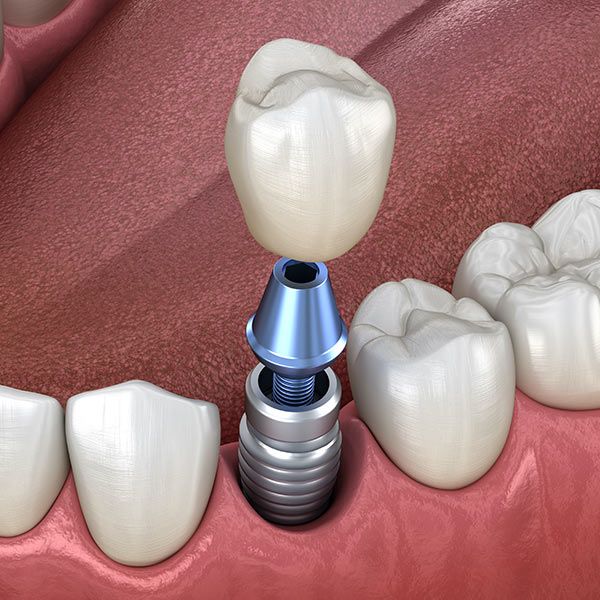 Implant crown