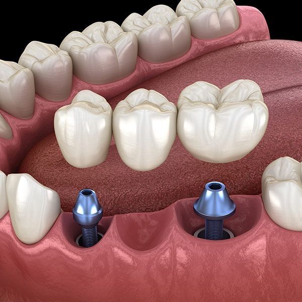 Implant bridge