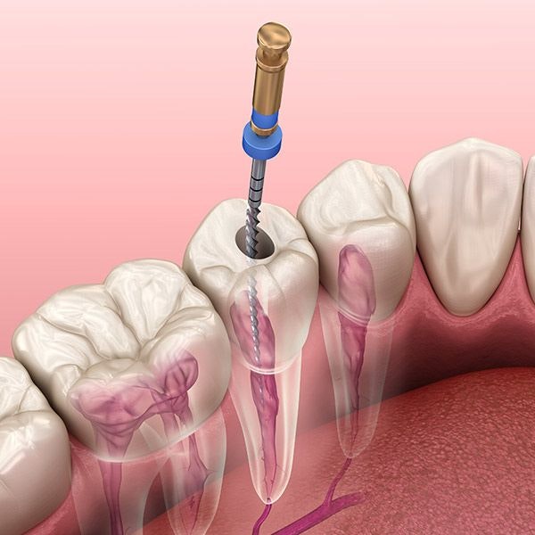 Root canal